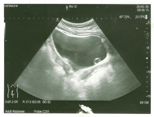 pęcherz moczowy /urotelecele