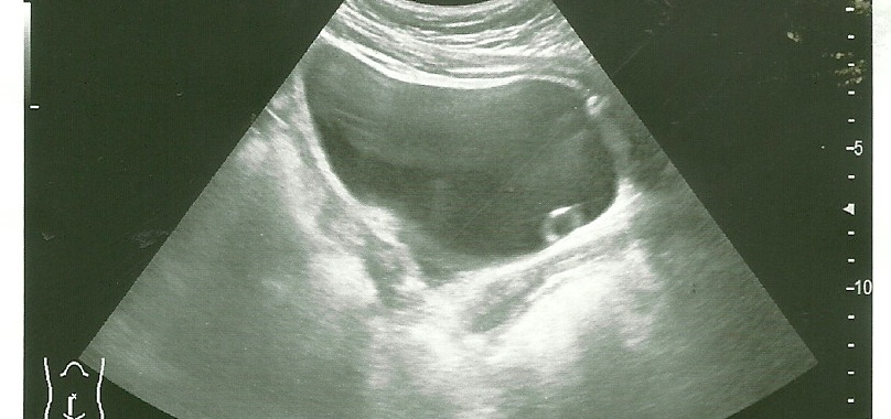 pęcherz moczowy /urotelecele